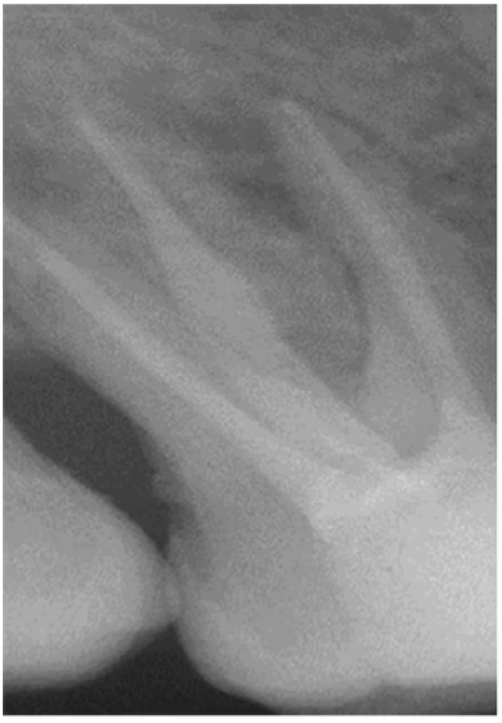 Check-up radiograph after 6 months
