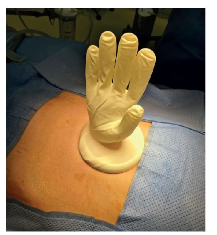 Uzavření retraktoru sterilní rukavicí<br>
Fig. 2: Retractor sealed with a sterile glove