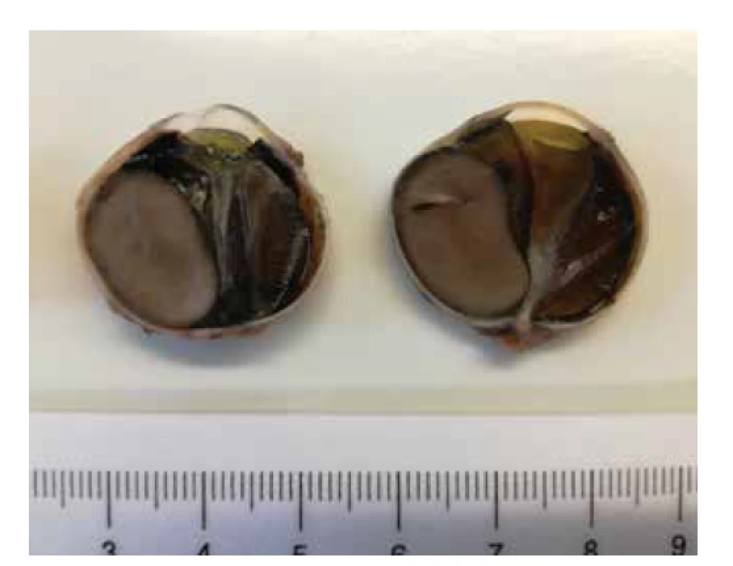 Makroskopický snímek enukleovaného bulbu – tumorózní
masa velikosti 17x11mm s mělkou invazí do skléry, bez angioinvaze,
bez invaze do optického nervu, bez nekróz.