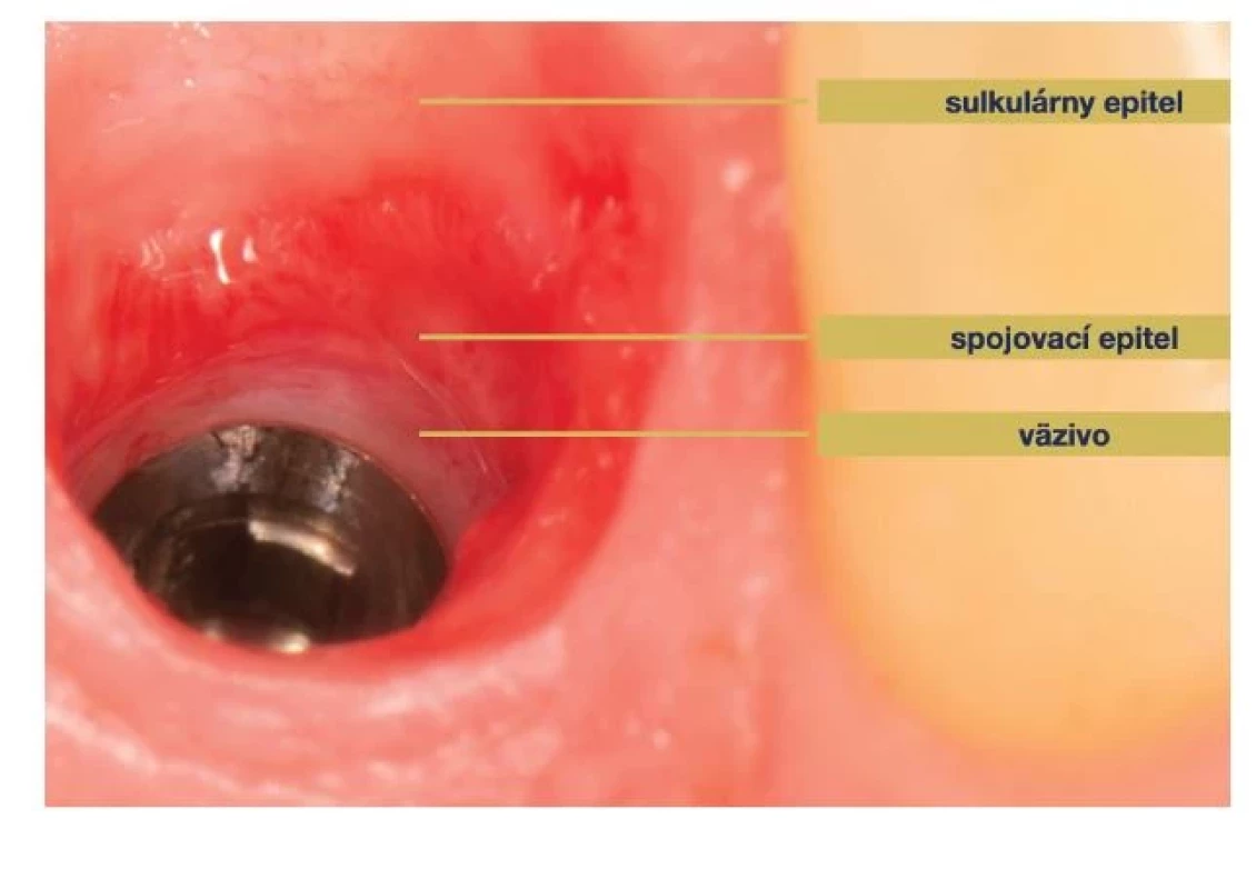 Suprakrestálne pripojené
tkanivá.<br>
Fig. 2
Supracrestal tissue
attachment.