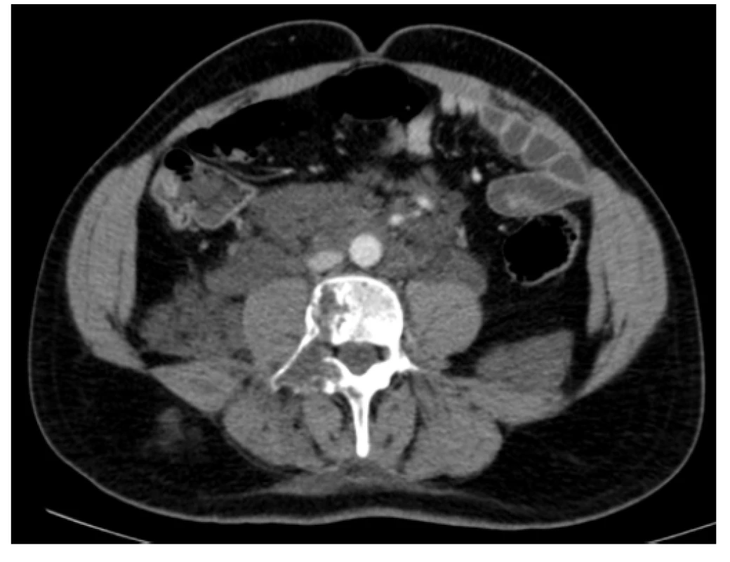 Kontrastní CT scan (axiální rovina) – patologická masa v oblasti
retroperitonea s propagací podél psoatů