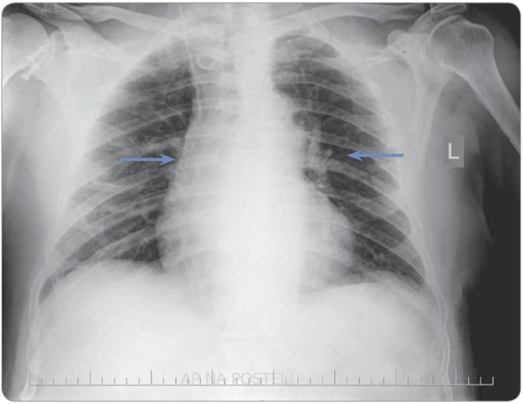 A chest radiograph in an antero-posterior position with the patient in a recumbent position; non-specifi c slightly increased perihilar vessel markings (blue arrows)
are visible.