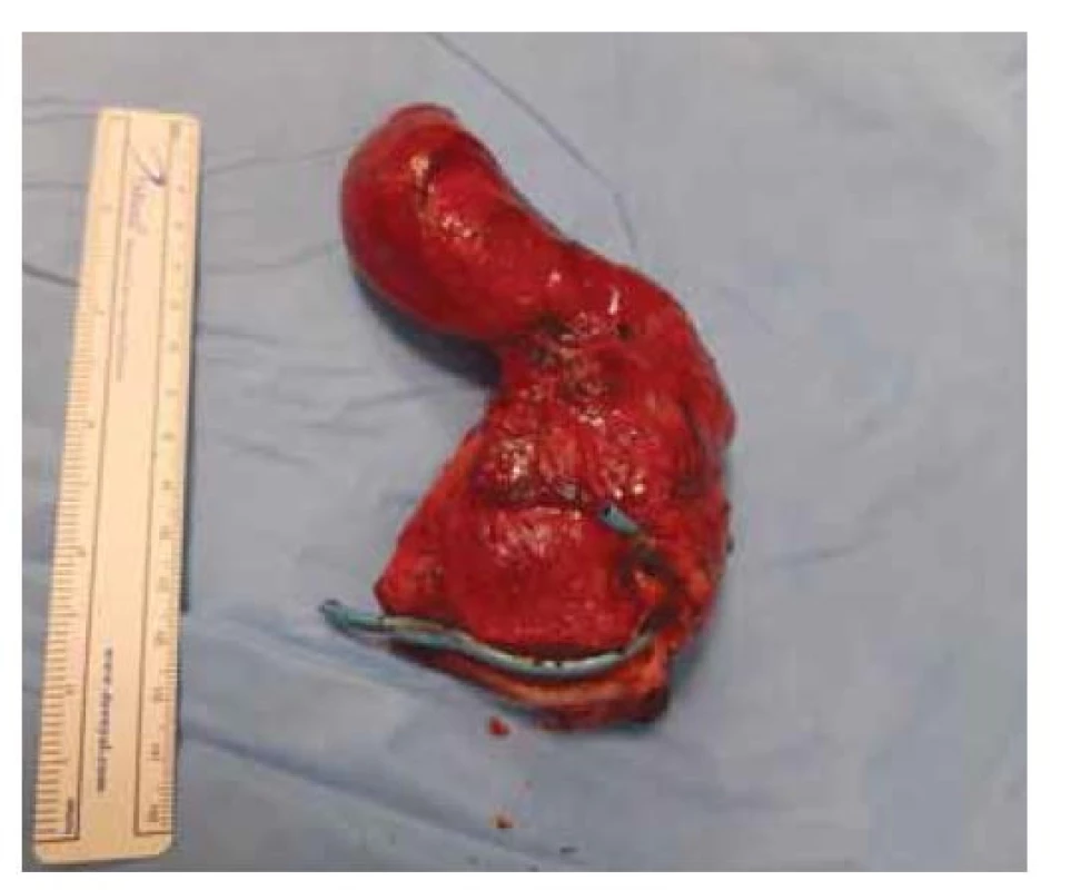 Resekát s viditelným plastovým stentem.<br>
Fig. 6. Resection with visible plastic stent.