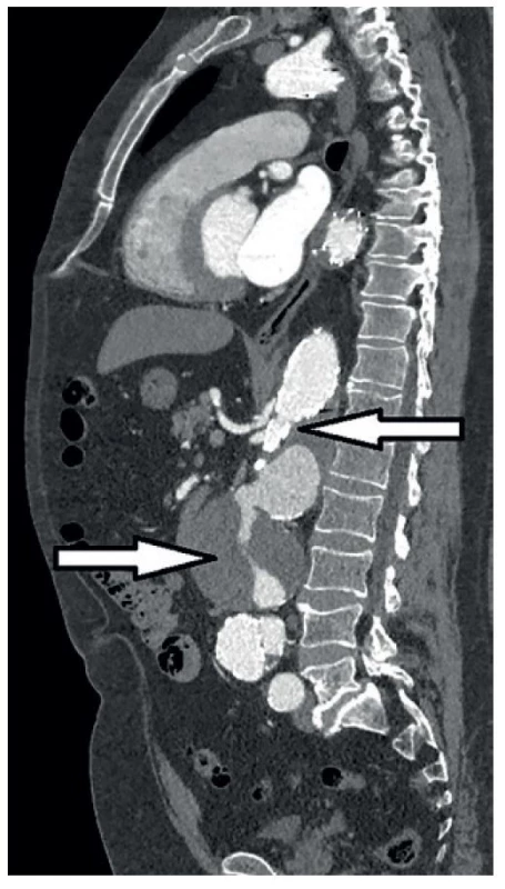 Endoleak I, komprese hrudního stentgraftu, aneuryzmatická
dilatace viscerální aorty<br>
Fig. 4: Endoleak type I, thoracic stent-graft compression,
visceral aortic aneurysmal dilatation