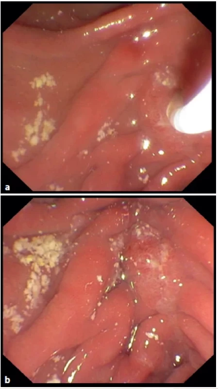 a, b: Endoscopic view following the third session
of extracorporeal shockwave lithotripsy – extraction of
stone fragments using an endoscopic balloon inserted
through the major papilla.