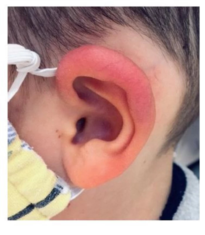 Borreliový
lymfocytom