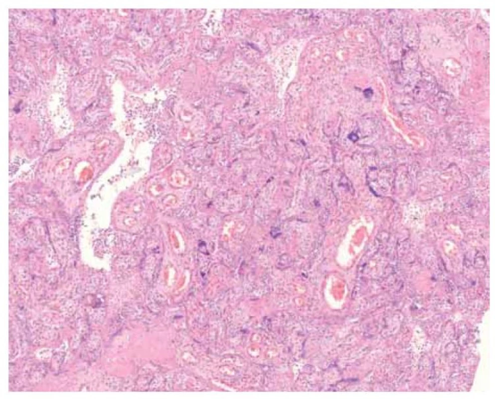 Histologický vzhled placenty v základním barvení – aglutinace klků,
nekróza buněk trofoblastu, zánětlivé změny v intervilózním prostoru.<br>
Fig. 3. Histological appearance of the placenta in the basic staining – agglutination
of the villi, trophoblast cell necrosis and inflammatory changes in the intervilous
space.
