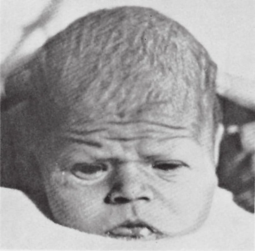 Kojenec s neléčenou vrozenou hypotyreózou v 10 měsících věku – převzato z [1].<br> Fig. 1. Untreated case of congenital hypothyroidism at the age of 10 months – adapted from [1].