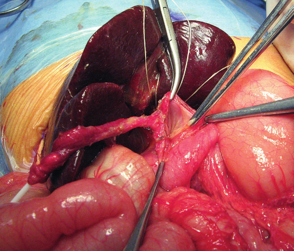Otvorená operácia vrodenej cystickej malformácie
žlčových ciest.<br>
Fig. 7. Open surgery of congenital biliary cystic malformation.