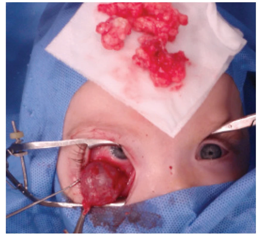 Perioperative photograph with evident cystic formation
and extracted fat tissues