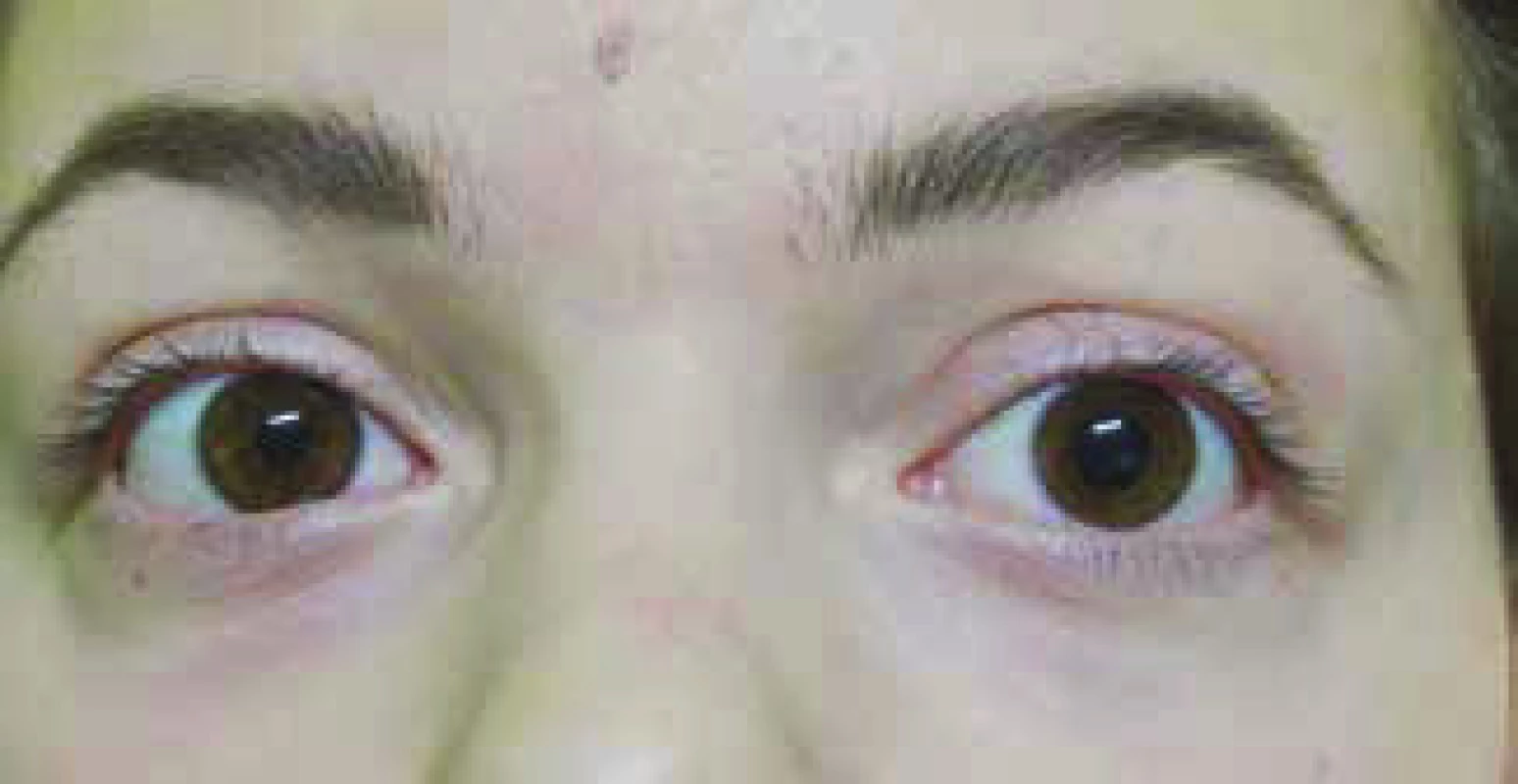 Anisocoria upon dilation of pupil of left eye in a
16-year-old patient
