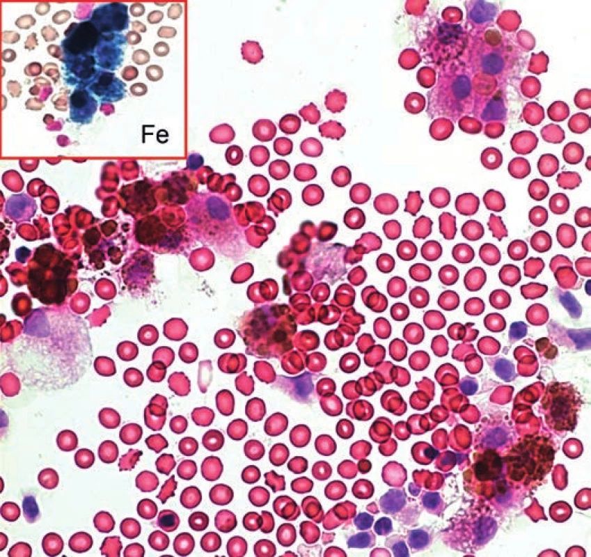 Hemoragická cysta bez možnosti bližšího zařazení. V krevním pozadí
hemosiderofágy a ojedinělé blíže nezařaditelné narušené buňky. HE, 200x.
Vložený obrázek – barvení na železo.