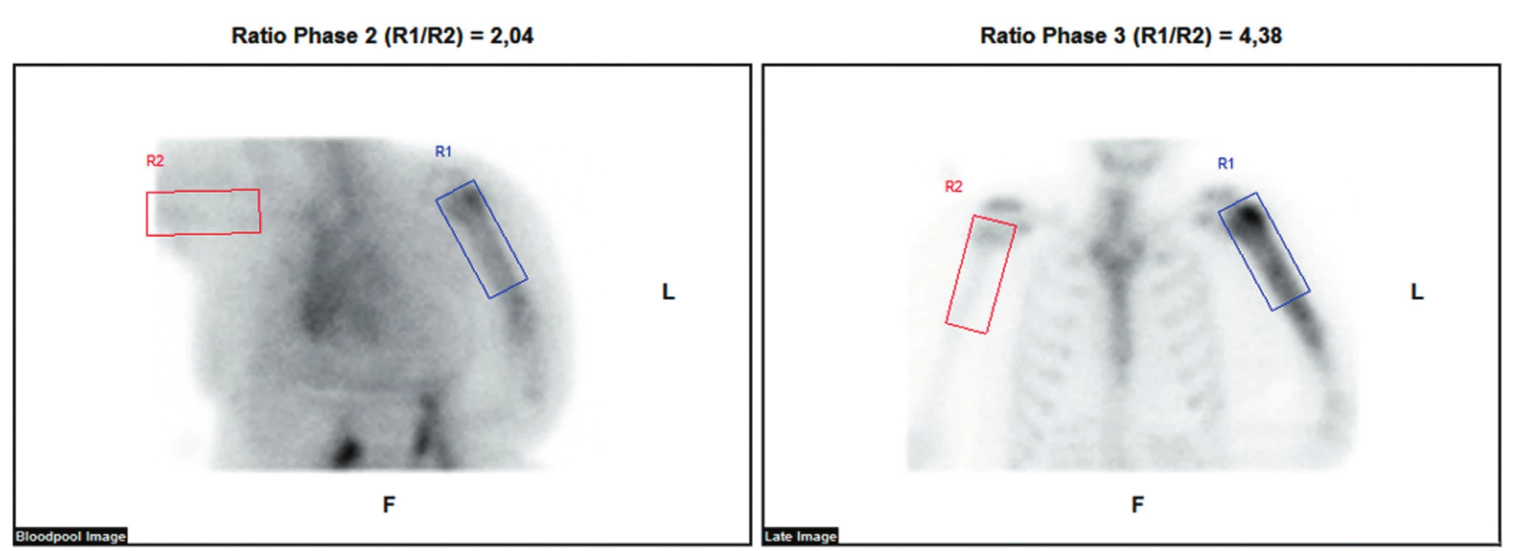 Provedená třífázová scintigrafie skeletu ukazuje ve fázi blood poolu nasnímané 5 minut po aplikaci radiofarmaka zvýšené tkáňové
prokrvení v oblasti diafýzy levé pažní kosti. Ve třetí fázi nasnímané za 2 h po aplikaci radiofarmaka je aktivita akumulována zvýšeně v proximálních
2/3 diafýzy s maximem v hlavici laterálně.