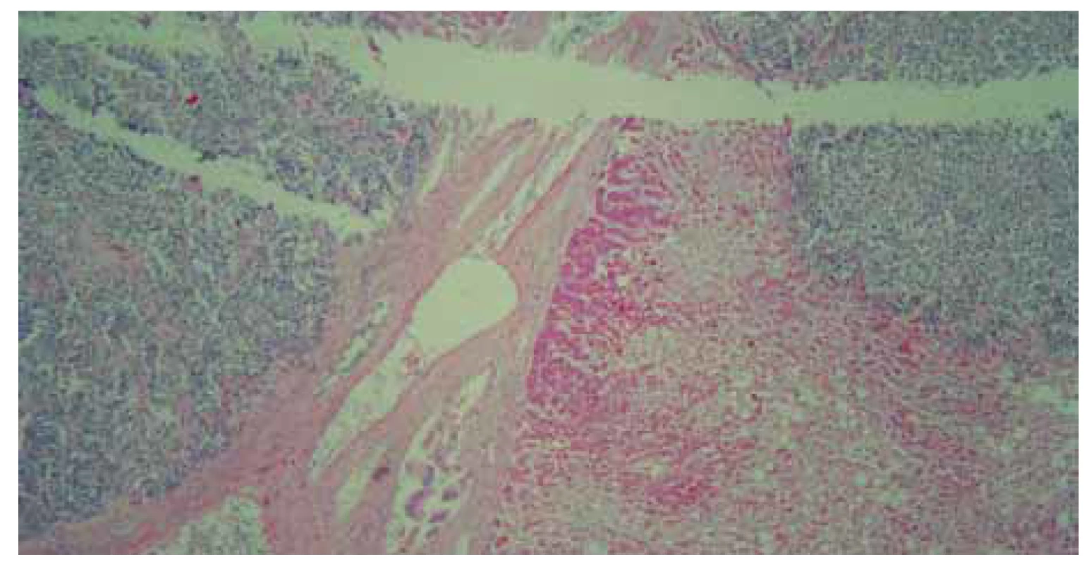 Imunohistochemické farbenie TTF-1, pozitivita v nádorových bunkách,
ktorá svedčí pre pľúcne origo.<br>
Fig. 9. Immunohistochemical staining of TTF-1, positivity in tumour cells suggesting
pulmonary origo.
