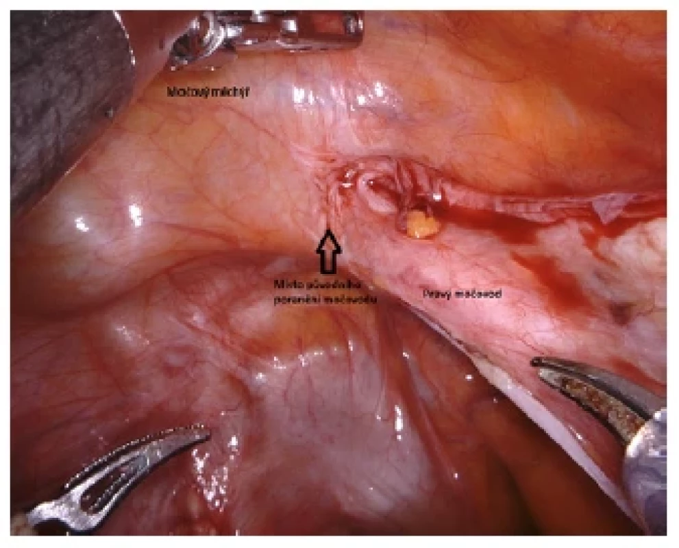 Výchozí stav operace, patrné místo poškození
močovodu <br> 
Fig. 1. The initial status of the surgery, visible site of
ureteral damage