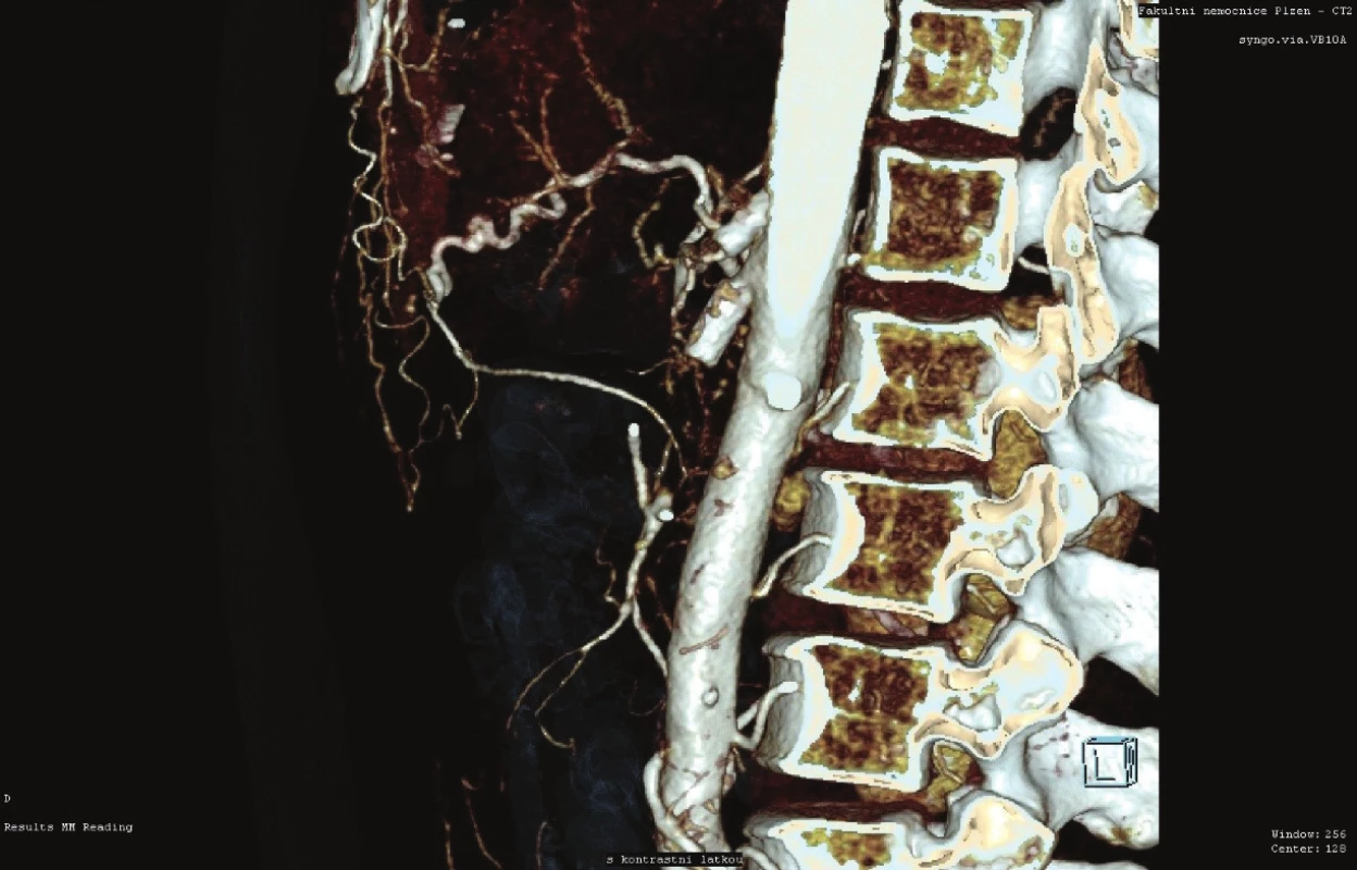 Selhání stentingu TC i AMS (CT AG)<br>
Fig. 1: Celiac trunk and superior mesenteric artery failure
(CT AG)