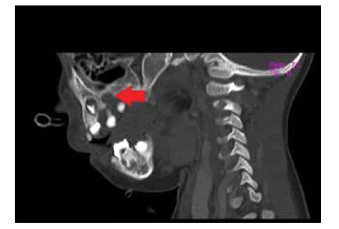 Osteolytický defekt nad alveolárnym výbežkom vľavo
v maxile u pacienta s multisystémovou histiocytózou z Langerhansových
buniek (zdroj: archív autorov).<br>
Fig. 3. Osteolytic defect above the alveolar ridge on the left
side of the maxilla in the patient with multisystem Langerhans
cell histiocytosis (source: authors’ archive).
