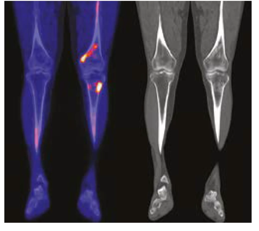 PET CT zobrazení pacineta č 2 DKK NaF a CT