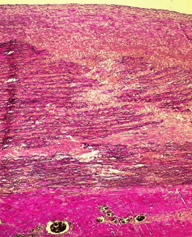 Multifocal fragmentation of elastic fibers (EVG x100).