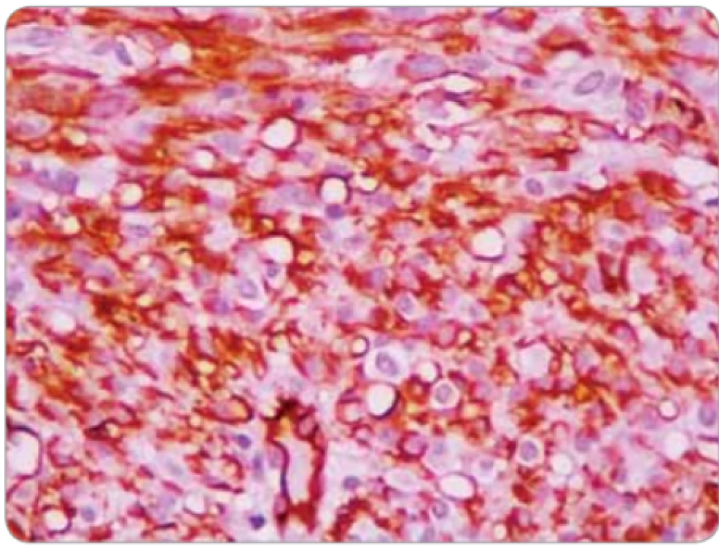 Positive immunoreactivity for CD34. 