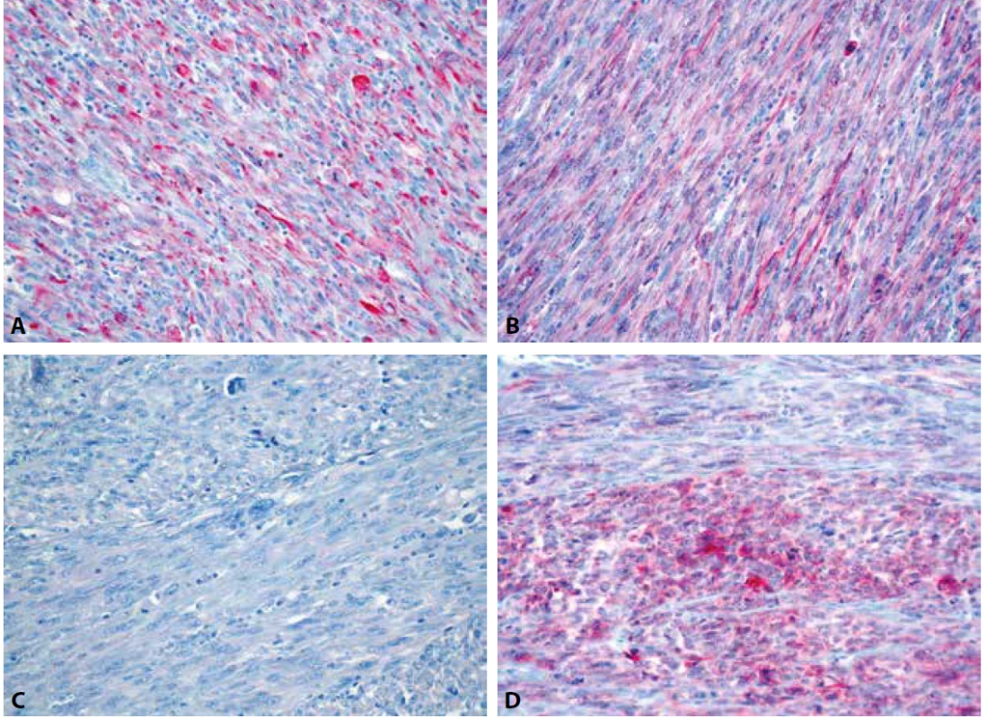 Variabilní exprese desminu (A), h-caldesmonu (B), hladkosvalového aktinu (C) a CD10 (D) v nádorových buňkách (IHC, 400x).