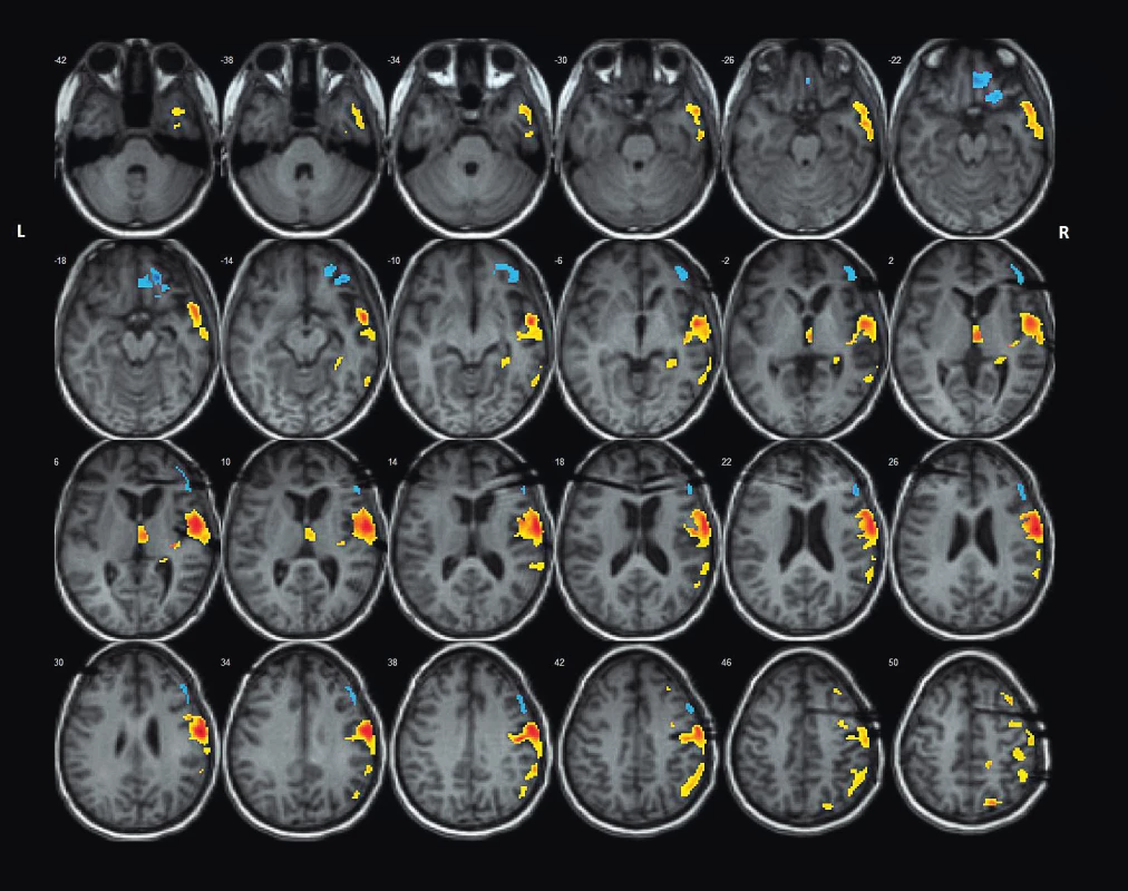 Pozice intracerebrálních EEG elektrod na MRI mozku ve vztahu ke koregistrovanému
maximu loko-regionálního FDG hypometabolismu dle
SPM-PET analýzy metodikou asymmetry index (stejná pacientka jako
na obr. 2).<br>
Fig. 3. Position of intracerebral EEG electrodes on brain MRI scan in relation to
co-registered regional FDG hypometabolism acc. to SPM-PET analysis
by Assymetry Index Method (the same patient as on the fig. 2).