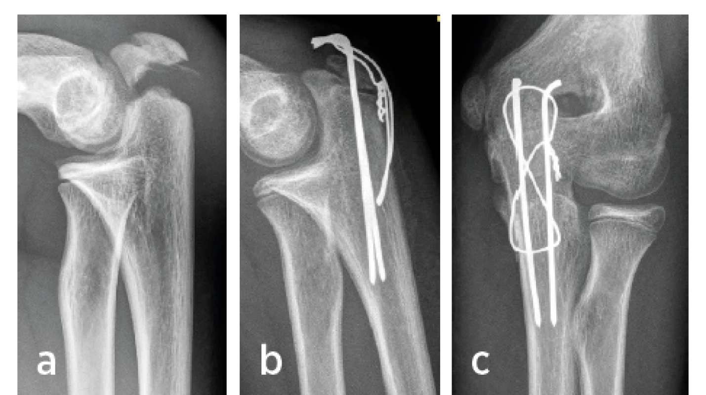 Chlapec 14 let, separace epifýzy olekranonu ulny
2. Salterova typu; a) úrazový snímek v bočné projekci
s klinicky významnou dislokací v distrakci úlomků;
b), c) po osteosyntéze a anatomickém, plně kongruentním
postavení fragmentů v AP i bočné projekci.<br>
Fig. 4. Boy 14-year-old, separation of the proximal ulnar
epiphysis (olecranon) of the 2nd type according to
Salter´s schedule; a) injury X-ray image in the lateral
projection – clinicaly significant fragment distraction;
b), c) X-ray images after osteosynthesis show the anatomical,
fully congruent fragment position in both PA
and lateral projections.