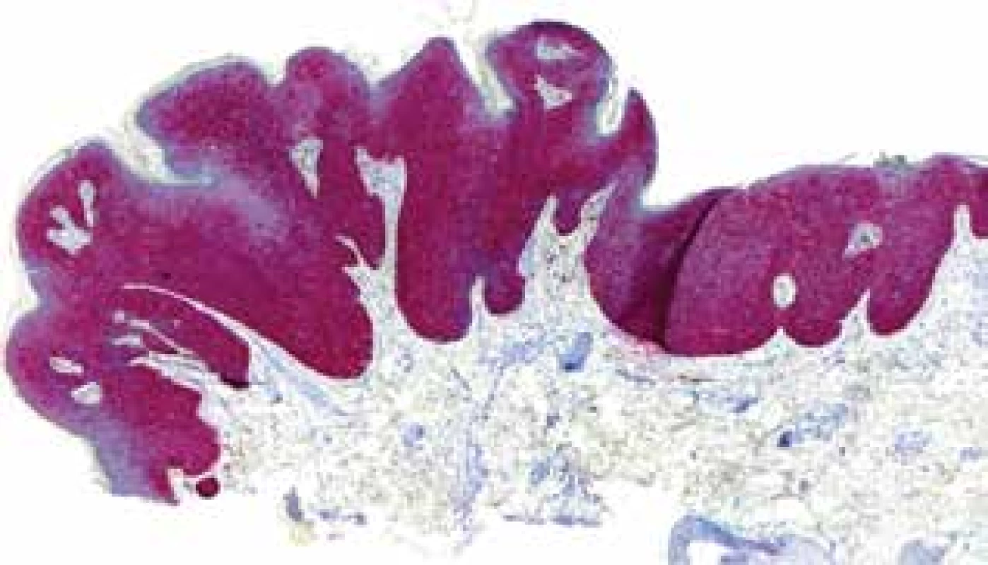 Imunohistochemické vyšetření s kompletní pozitivitou
p16
