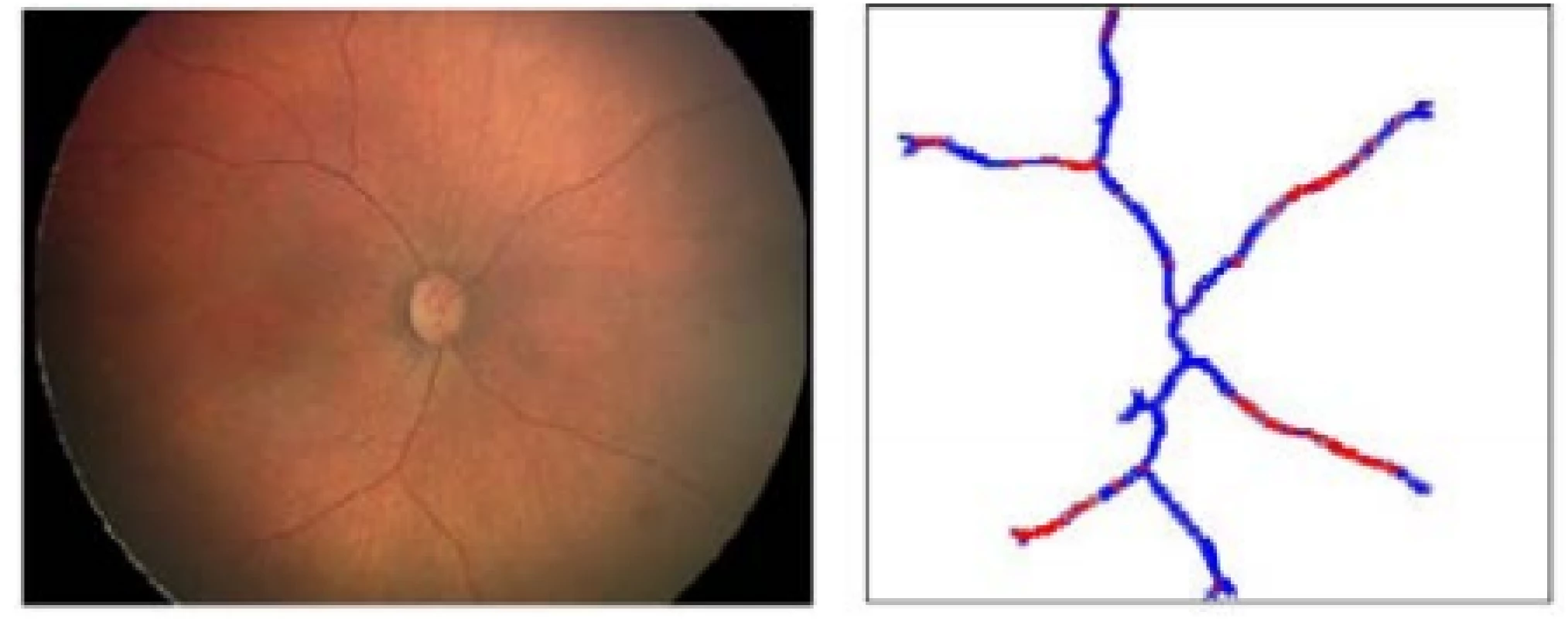 Native image (left), multiple thresholding of
tortuosity in retinal blood vessels image (right)