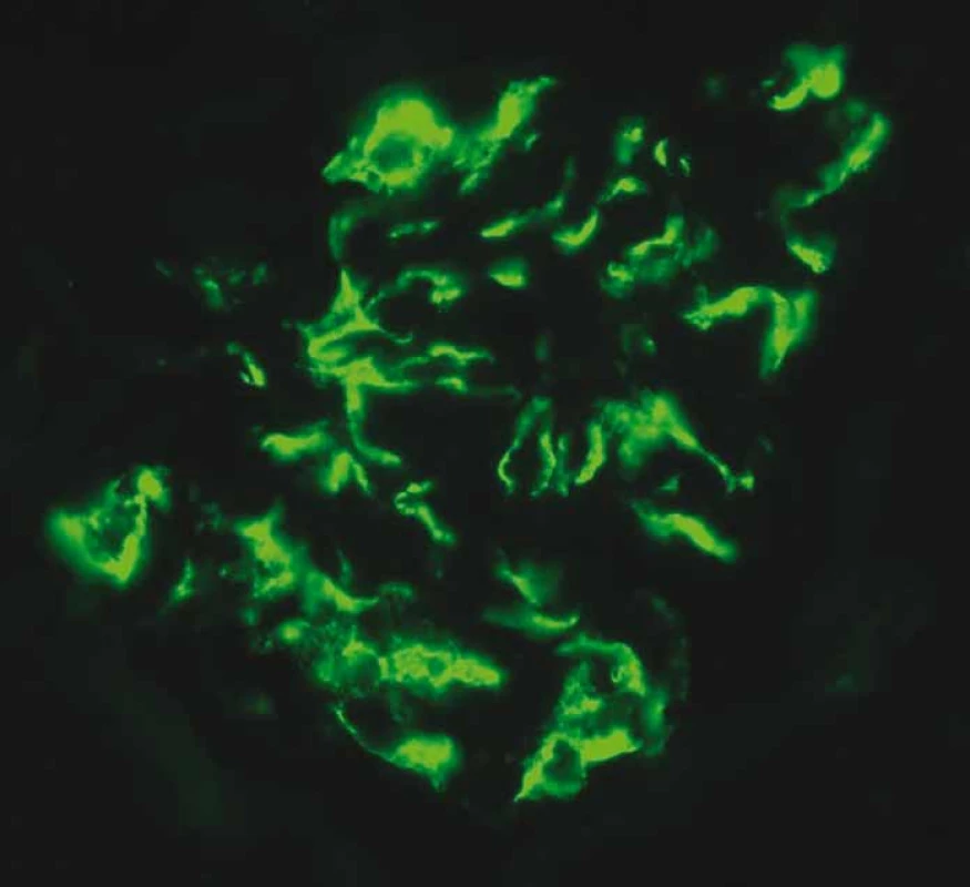Imunofl uorescenční vyšetření – pozitivní detekce imunoglobulinu A
(IgA) v mezangiu odpovídá IgA glomerulonefritidy.
Renální biopsie 12/2018 uskutečněna na Klinice nefrologie, Transplantcentrum,
IKEM, přednosta prof. MUDr. O. Viklický, CSc., bioptické nálezy zhodnoceny
a poskytnuty laskavostí doc. MUDr. E. Honsové Ph.D., přednostky Pracoviště
klinické a transplantační patologie, Transplantcentrum, IKEM).<br>
Fig. 1. Immunofl uorescence examination – positive detection of immunoglobulin A
(IgA) in mesangium corresponds to IgA glomerulonephritis.