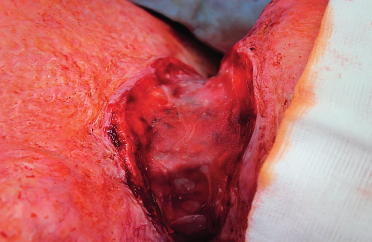 Matriderm® application on the site of the defect