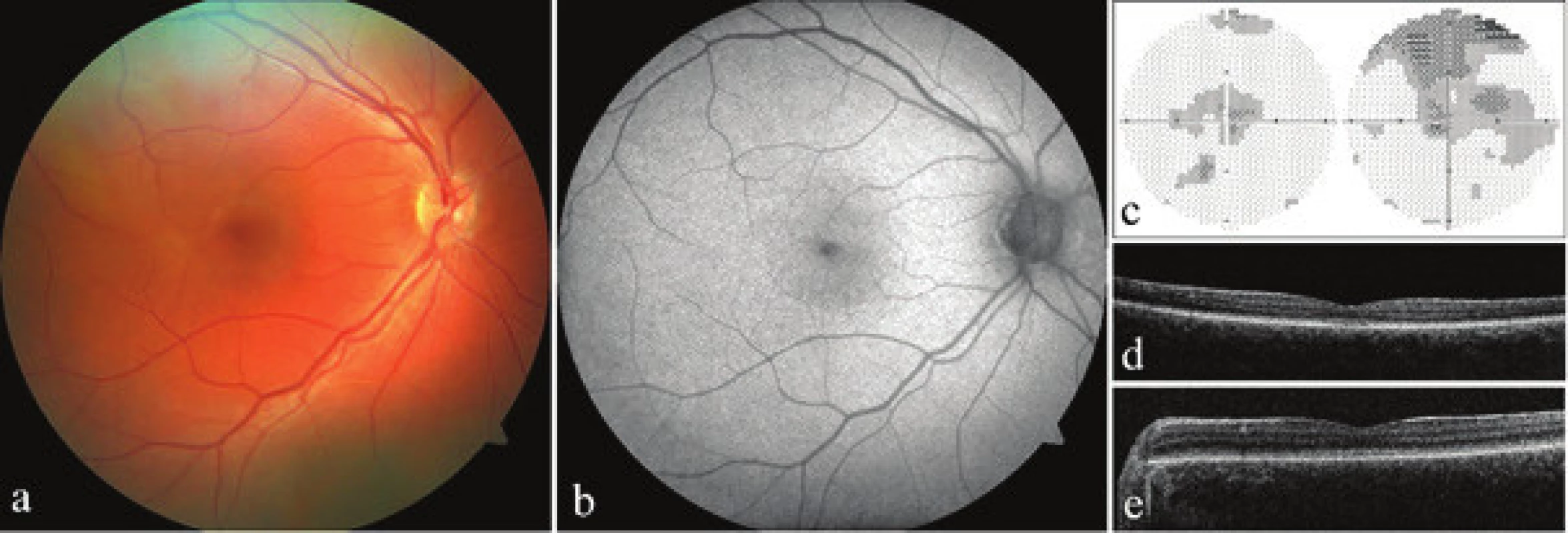 Clinical finding in both probands with achromatopsia. a) photograph of fundus of right eye of proband 1, b) autofluorescence
of fundus of right eye of proband 1, c) perimeter of right and left eye of proband 1, d) optical coherence
tomography with spectral domain (SD-OCT) of left eye of proband 1, d) SD-OCT of left eye of proband 2