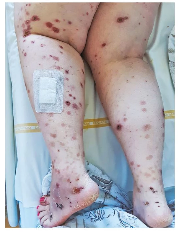 Rozsev kožních vaskulitických eflorescencí na dolních končetinách
43leté nemocné s granulomatózou s polyangiitidou a difuzní alveolární
hemoragií (archiv autorky)