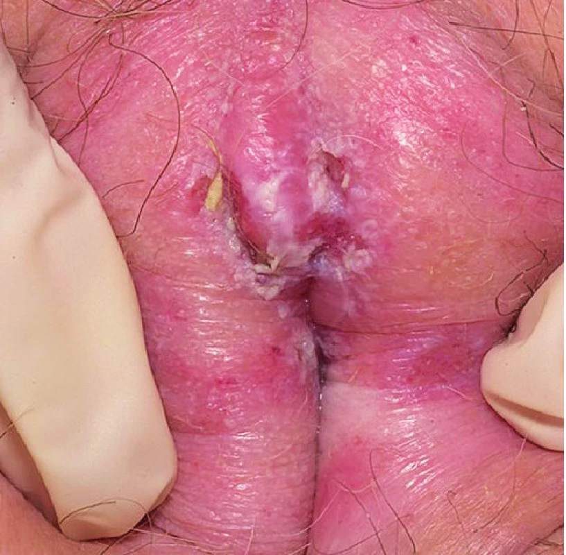 Lichen sclerosus (foto autor). Projevuje se oválnými
makulopapulami se svraštělým povrchem a ztluštěním horní
vrstvy kůže. Výsev je spojen se svěděním, rozvojem ragád a erozí
s rizikem stenózy poševního introitu. S tím souvisí dyspareunie,
dysurie a nemožnost pohlavního styku.