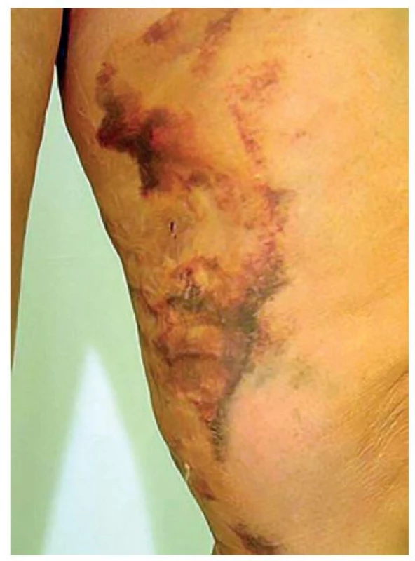 Hematom po laserové ablaci velké safény v pulzním
módu<br>
Fig. 3: Haematoma after laser ablation of great saphenous
vein in pulse mode