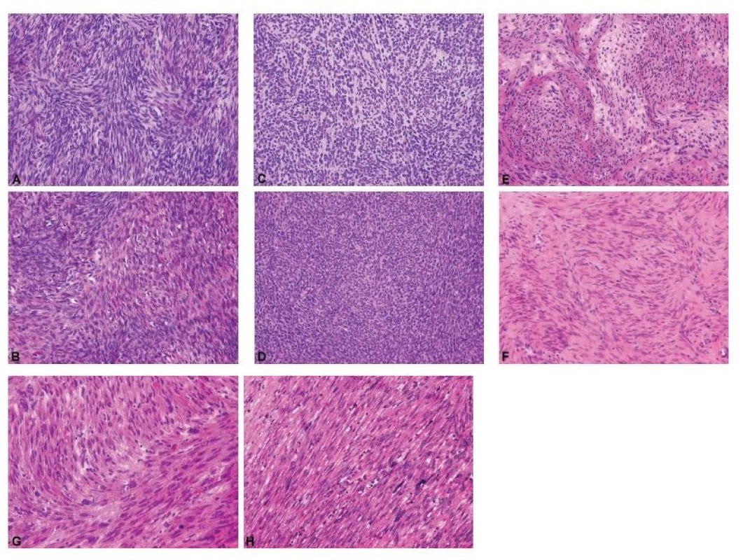 Fascikulárně stavěné gonadostromální a mezenchymální nádory ovaria jako diferenciálně diagnostický problém při peroperačním vyšetření.<br>
A – celulární fibrom (peroperační vyšetření, HE, 200x);
B – celulární fibrom (definitivní vyšetření, HE, 200x);
C – nádor z buněk granulózy, adultní typ, sarkomatoidní
varianta (peroperační vyšetření, HE, 200x); D – nádor
z buněk granulózy, adultní typ, sarkomatoidní varianta
(definitivní vyšetření, HE, 200x); E – leiomyom (peroperační
vyšetření, HE, 200x); F – leiomyom (definitivní
vyšetření, HE, 200x); G – leiomyosarkom (peroperační
vyšetření, HE, 200x); H – leiomyosarkom (definitivní
vyšetření, HE, 200x)