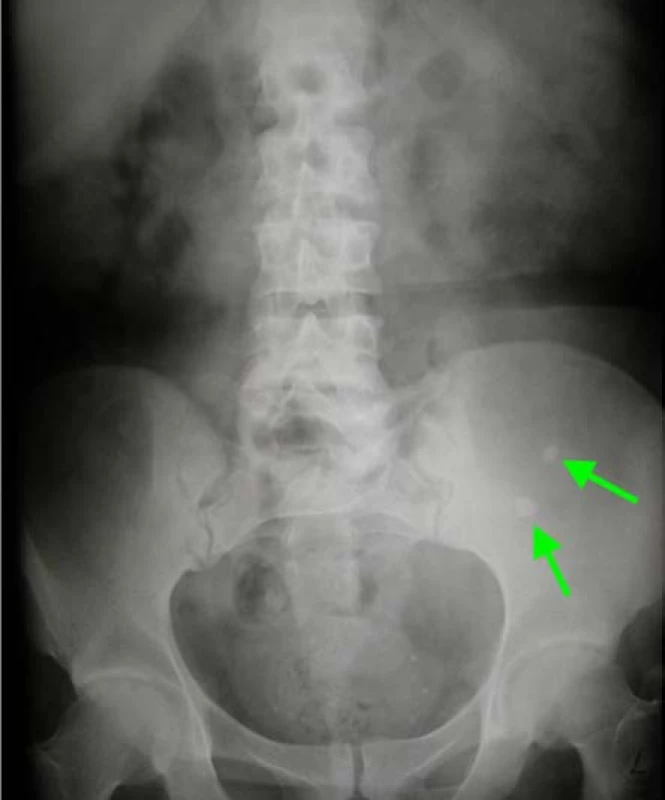 Nefrolitiáza transplantovanej obličky<br>
Fig. 12. Nephrolithiasis in the transplanted kidney