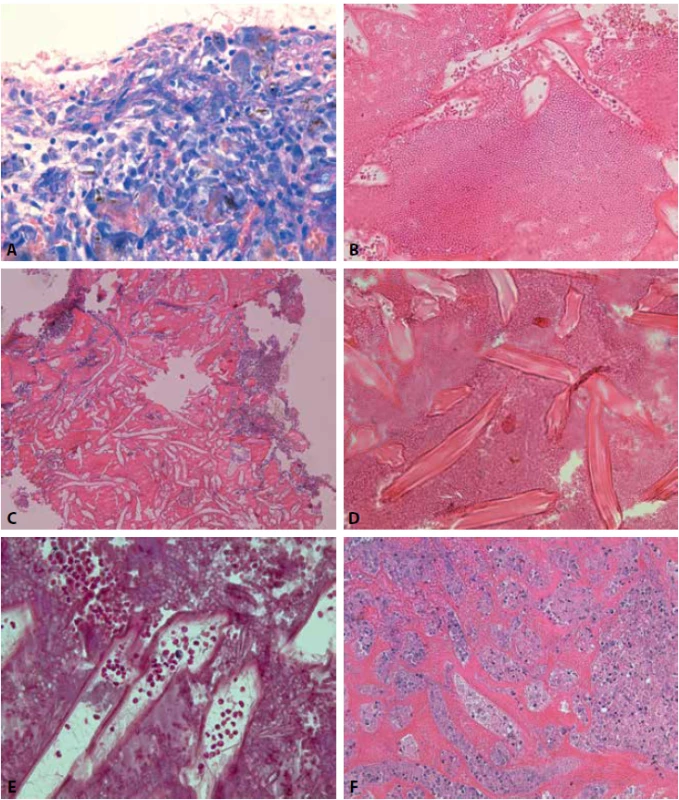 (A) Nešpecifické granulačné tkanivo s prítomnosťou hemosiderínu (hnedý pigment). (Giemsovo farbenie, obj. 40x). (B) Tkanivo pseudotumoru. Eozinofilný materiál s tieňmi erytrocytov (HE, obj. 20x). (C) Iné zorné pole s nekrotickým tkanivom a s opticky prázdnymi priestormi podlhovastej štruktúry (HE, obj. 10x). (D) Cudzorodý materiál v prekrvácanom granulačnom tkanive (HE, obj. 20x). (E) V opticky prázdnych priestoroch cudzorodého materiálu sa nachádzajú tenké „pavučinkové“ vlákna typické pre použitie surgicelu. (Massonov trichróm, obj. 40x). (F) Bazofilný bunkový detritus v nekrotickom granulačnom tkanive s prítomnosťou fibrínu (HE, obj. 20x).