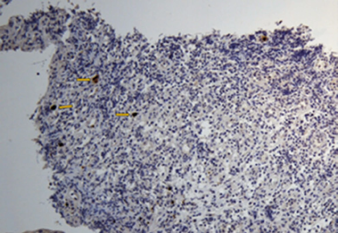 CMV inkluze, imunohistoch. vyš, 40×