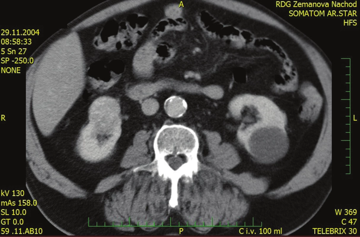 CT břicha, světlobuněčný nádor pravé ledviny<br>
Fig. 1: Abdominal CT – RCC l.dx.