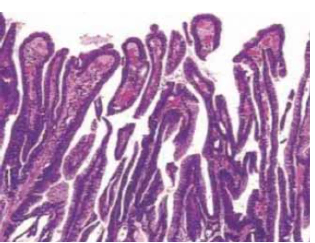 Histologic picture of papillary
gastric adenocarcinoma (hematoxyline-
eosin staining, magnifi cation
200×).<br>
Obr. 6. Histologický obraz papilárneho
adenokarcinómu žalúdka (hematoxylín-
eozín barvenie, zväčšenie 200×).