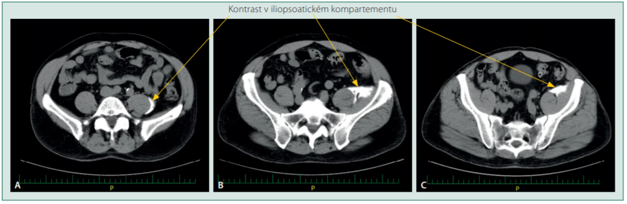 Fascia iliaca blok: náplň střední části iliopsoatického kompartmentu po aplikaci 50 ml roztoku suprainguinálním přístupem: horizontální řezy
na úrovni A: L5, B: S1, C: S3. Lokální anestetikum je striktně v psoatickém (A) a iliopsoatickém fasciálním kompartmentu (B a C)