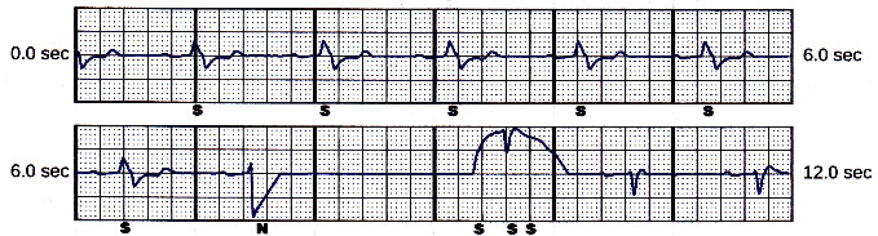 Alternate sensing vector snapshot. Beat
marked “N” is noise