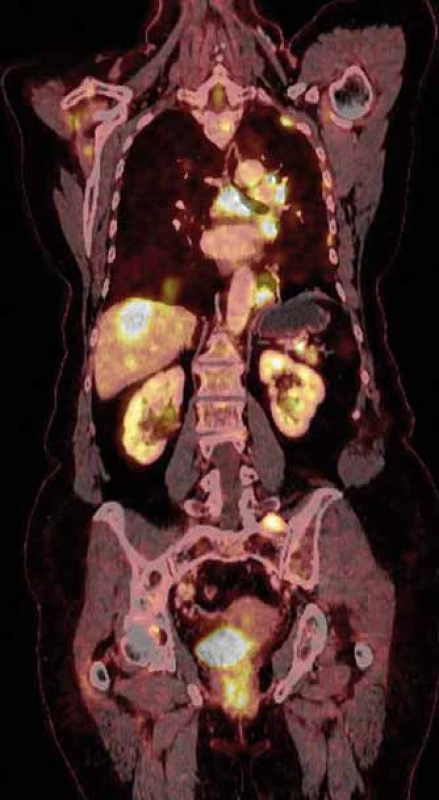 PET/CT zobrazení mnohočetného
postižení žaludku, pankreatu a skeletu.