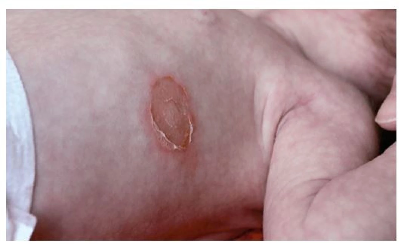 Třítýdenní novorozenec s bulózním impetigem – zdrojem
byla 4letá sestra, která navštěvovala školku a měla impetigo v obličeji