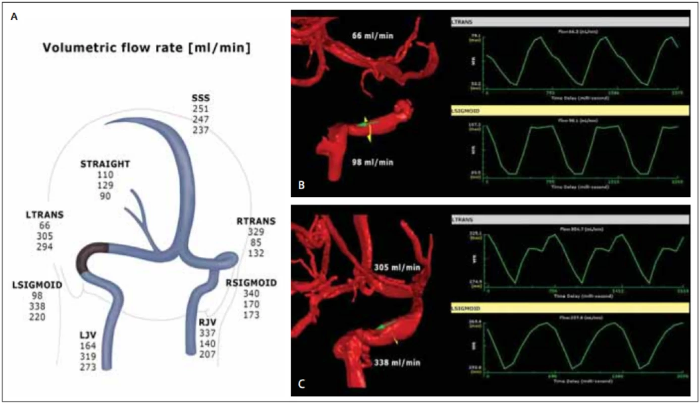 (A) qMRV – hemodynamická mapa žilní drenáže mozku. Výsledky průtoků v ml/min jsou řazeny chronologicky, horní hodnota
– před zavedením stentu, střední – 1. den po zavedení stentu, dolní – s odstupem 6 týdnů; (B) 3D model stenotického úseku přechodu
levého s. transversus a s. sigmoideus s nízkým průtokem; (C) signifi kantní nárůst průtoků po implantaci stentu při kontrole 1. den po
intervenci.<br>
Fig. 1. (A) qMRV – haemodynamic map of cerebral venous drainage, fl ow values in ml/min: upper number – before stenting, middle
number – day 1 after stenting, lower number – at 6 weeks after stenting; (B) 3D model of the stenosis of the transitional segment
between the left transverse and sigmoid sinuses with a low fl ow; (C) signifi cant fl ow increase after stent insertion at day 1 follow-up.