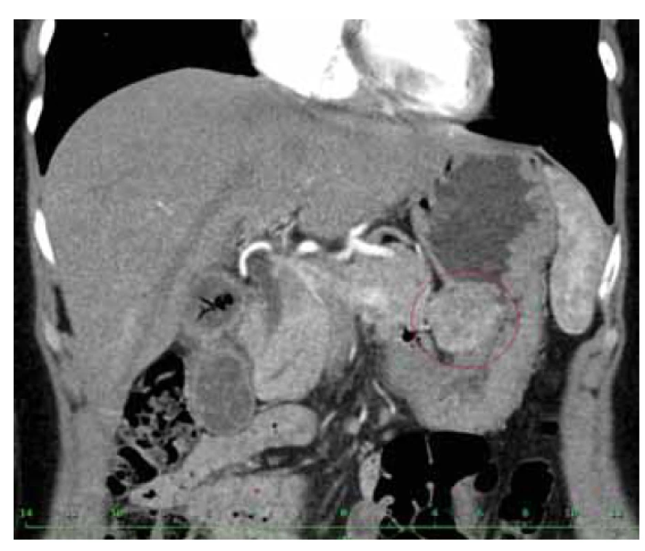 Vyšetření počítačovou tomografií (CT) hladce ohraničeného
kulovitého útvaru na malé kurvatuře žaludku
průměru 36 mm.<br>
Fig. 1. Image from computer tomography showing smoothly
delimited spherical tumour on the stomach lesser curvature
with a diameter of 36 mm.