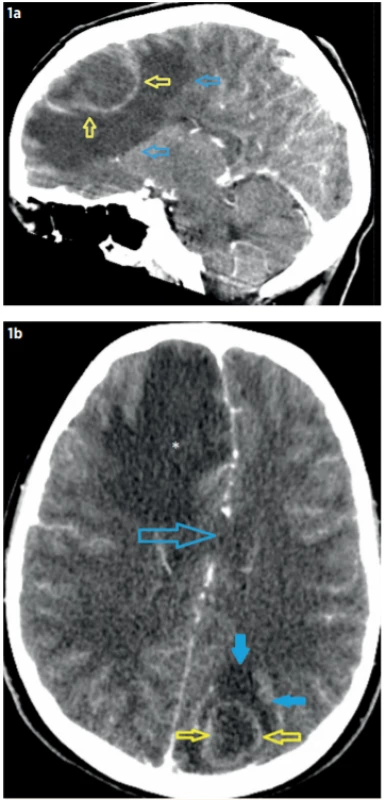 CT mozku při přijetí pacienta (7. 7. 2019).
a – Postkontrastní CT, sagitální rekonstrukce: absces
(46 x 28 x 34 mm) frontálně vpravo (žluté šipky)
s výrazným perifokálním edémem (modré šipky);
b – Postkontrastní CT, axiální rovina: absces okcipitálně
vlevo (26 x 23 x 21 mm, žluté šipky) s výrazným perifokálním edémem (modré plné šipky), přesun středočárových struktur doleva (otevřená modrá šipka). Vpravo
frontálně okrsek edému (hvězdička) v okolí abscesu.<br>
Fig. 1. Brain CT in patient admission (7. 7. 2019). Frontal right-sided abscess (46 x 28 x 34 mm) and occipital left-sided abscess (26 x 23 x 21 mm) with perifocal edema.