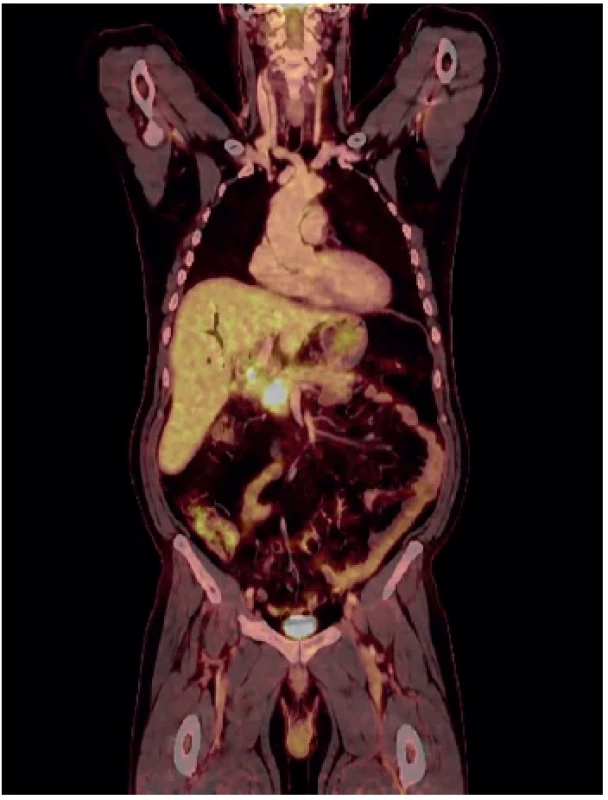 PETCT u lokálně pokročilého tumoru hlavy pankreatu
v terénu chronické pankreatitidy, 1 rok po stanovení
diagnózy, bez léčby <br> 
Fig. 2. PETCT of a locally advanced tumor of the head of
the pancreas in chronic pancreatitis, 1 year following the
diagnosis, without therapy