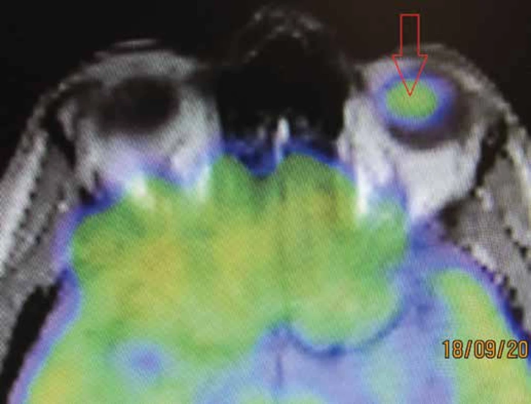 PET/CT examination – arrow indicates capturing of radiopharmaceutical in the
region of the uveal melanoma 